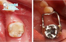 十一月儿童牙科病例