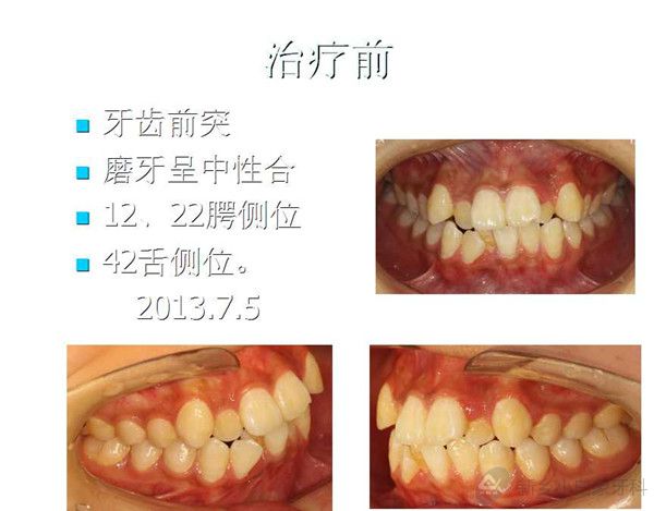 八月份病历展示正畸科安氏一类错合拔牙矫治