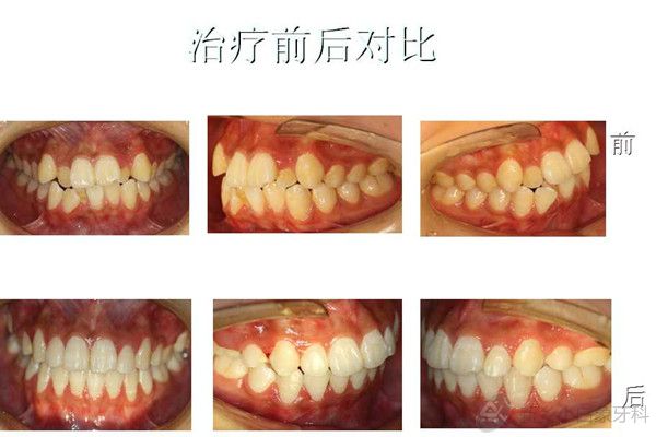 八月份病历展示正畸科安氏一类错合拔牙矫治