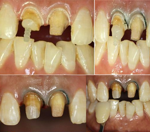 九月份修复病例展示
